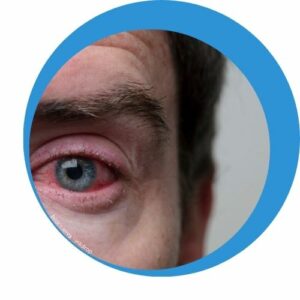 Teilaufnahme von einem Mann mit gerötetem Auge zum Thema: Allergie Symptom gerötete Augen